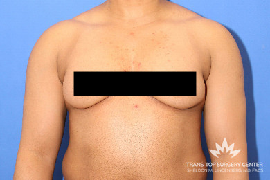 female to male top surgery atlanta